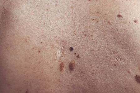 A melanocytic nevus also known as nevocytic or nevus-cell nevus and commonly as a mole is a type of melanocytic tumorの写真素材