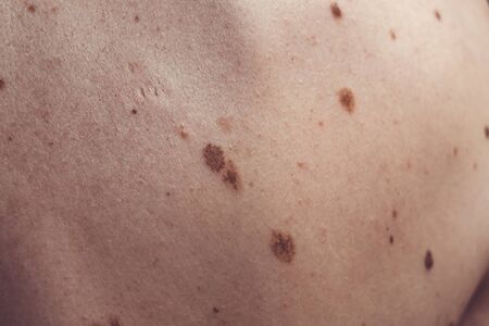 A melanocytic nevus also known as nevocytic or nevus-cell nevus and commonly as a mole is a type of melanocytic tumorの写真素材