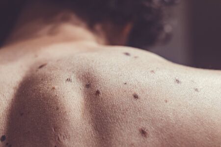 Melanocytic nevus, some of them dyplastic or atypical, on a caucasian man of 37 years old from Spainの写真素材