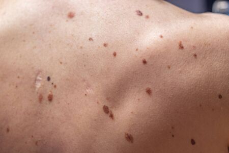 Melanocytic nevus, some of them dyplastic or atypical, on a caucasian man of 37 years old from Spainの写真素材