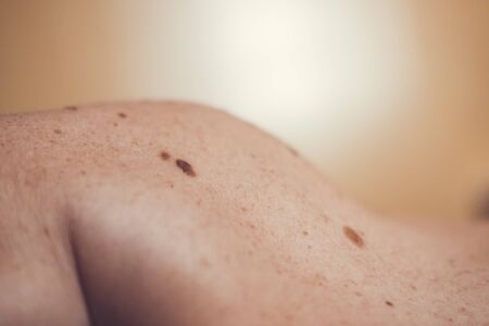 Melanocytic nevus, some of them dyplastic or atypical, on a caucasian man of 37 years old from Spainの写真素材