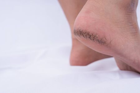 Close-up of dry and cracked heel with black bad skin on white background. Medical, healthcare for advertising concept.の写真素材