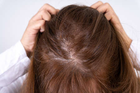 Close up woman head hair loss. Thinning hair on head. Healthcare medical or daily life concept.の写真素材
