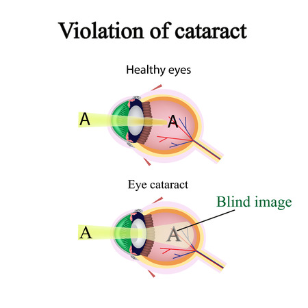 The structure of the eye. Cataracts. As the affected eye sees cataracts. Violation of cataract.のイラスト素材