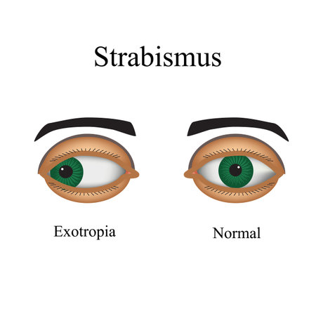 Diseases Of The Eye Strabismus A Variation Of Strabismus Exotropia Tasmeemme Com