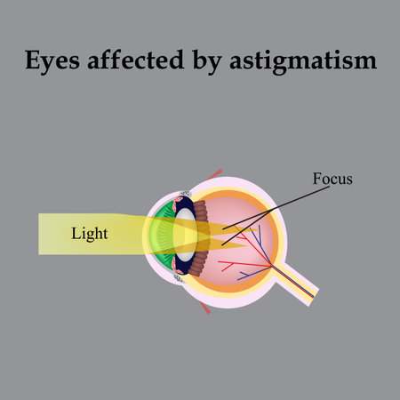 Impaired vision with astigmatism. As astigmatism affect vision.のイラスト素材