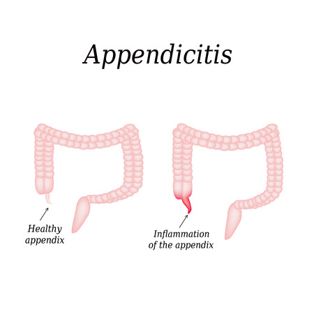 Appendicitis. Inflammation of the appendix. Colon. The illustration on isolated background.のイラスト素材