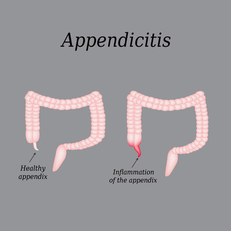 Appendicitis. Inflammation of the appendix. Colon. The illustration on a gray background.のイラスト素材
