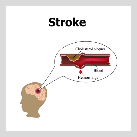 Bleeding in the brain. Insult.. Stroke, atherosclerosis. Cholesterol plaques. Infographics. のイラスト素材