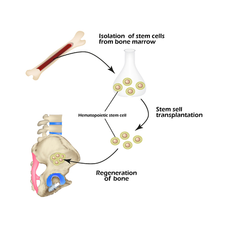 Stem cells from bone marrow are used for bone regeneration. Infographics. Sacral region, sacrum.のイラスト素材