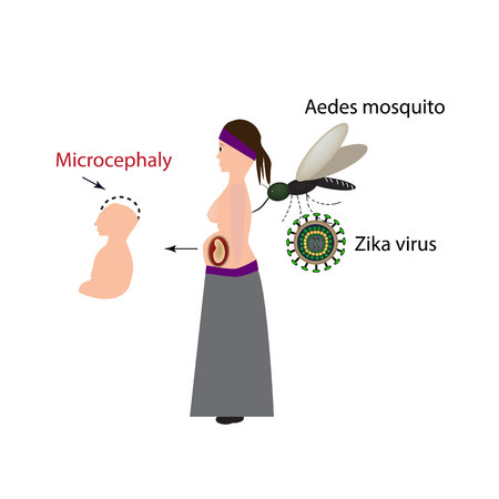 Zika virus. Infection of a pregnant woman. Mosquito bite. Microcephaly in the infant. Infographics. illustration.のイラスト素材