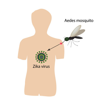 Zika virus. Mosquito bite. Infographics. illustration.のイラスト素材