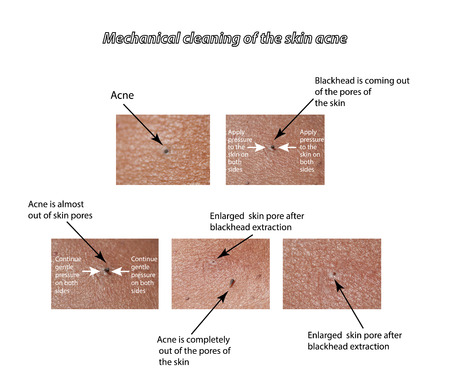 Mechanical cleaning of the skin from acne.の写真素材