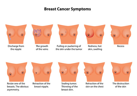 Symptoms of breast cancer. Infographics.のイラスト素材