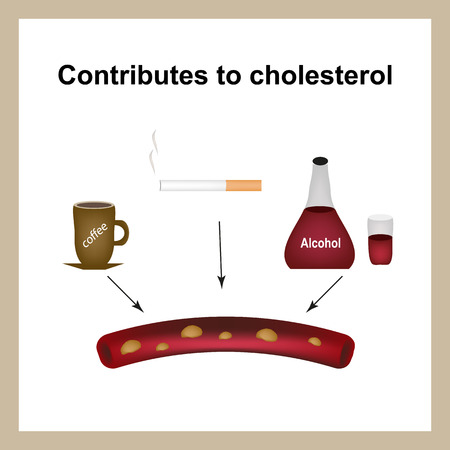 Coffee, cigarettes and alcohol raise cholesterol levels in the blood. Cholesterol plaques. Infographics. Vector illustration an isolated backgroundのイラスト素材