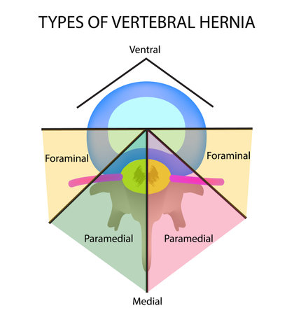 Types of location of the intervertebral hernia.のイラスト素材