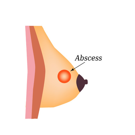 Abscess in the mammary gland. World Breast Cancer Day. Vector illustration on isolated background.のイラスト素材