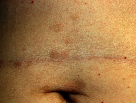 Red Flat Lichen planus. Red spots on the skin of the abdomen.