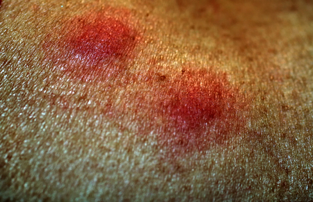 Red mosquito bites. Swelling of the skin. A bite of a wasp, a beeの写真素材