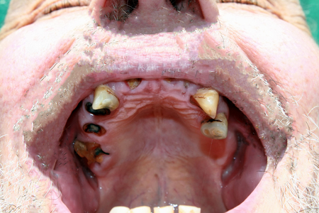 Rotten bad teeth. Caries. Periodontal disease Dentalの写真素材