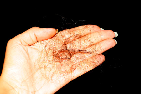 A dropped stick of hair in his hand. Hair lossの写真素材
