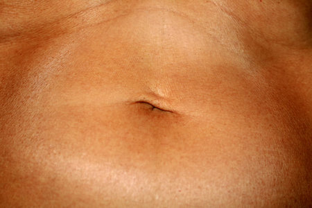 Flabby wrinkled abdomen. The navel is stretched