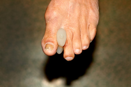 Interdigital pads. partitions. Foot. Corn on toes. Curvature of fingers. Interdigital Corn pad