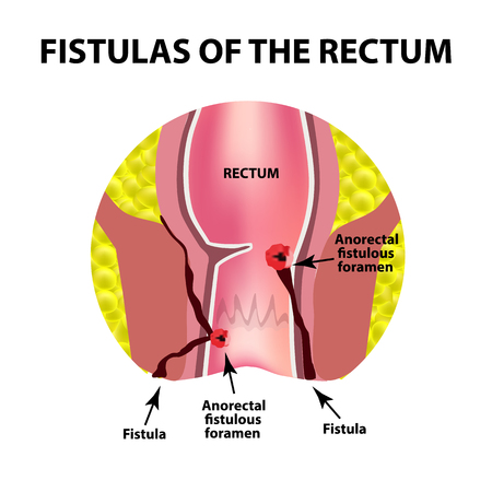 Types of fistulas of the rectum. Paraproctitis. Anus. Abscess of the rectum. Infographics. Vector illustration on isolated background.のイラスト素材