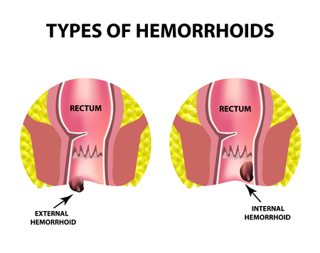 Two types of hemorrhoids are external and internal. Rectum structure, intestines. colon. Internal and external hemorrhoidal node infographics vector illustration on isolated background.のイラスト素材