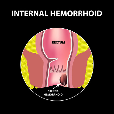 Hemorrhoids internal. Rectum structure. Intestines. colon. Internal hemorrhoidal node. Infographics. Vector illustration on black background.のイラスト素材