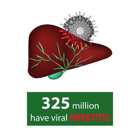 325 million have viral hepatitis. Liver and hepatitis virus. World Hepatitis Day. Infographics. Vector illustration on isolated backgroundのイラスト素材