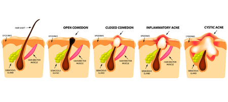 Types of acne. Open comedones, closed comedones, inflammatory acne, cystic acne. The structure of the skin. Infographics. Vector illustration on isolated backgroundのイラスト素材