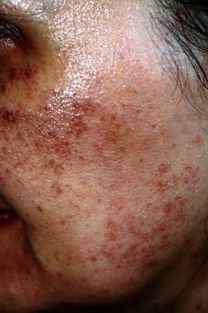 Pigmented spots on the face. Pigmentation on cheeks.の写真素材
