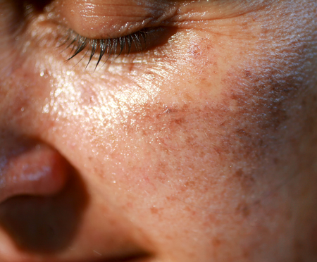 Pigmented spots on the face. Pigmentation on cheeks.の写真素材