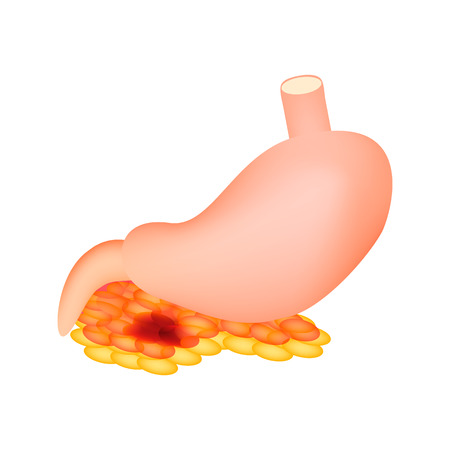 Pancreatitis. The structure of the stomach and pancreas. Infographics. Vector illustration on isolated backgroundのイラスト素材