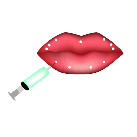 Injections for lip augmentation. Designation of places for injections. Hyaluronic acid. Infographics. Vector illustration on isolated background.のイラスト素材
