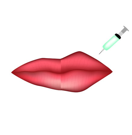 Injections for lip augmentation. Lips before and after cosmetic procedure. Hyaluronic acid. Infographics. Vector illustration on isolated background.のイラスト素材