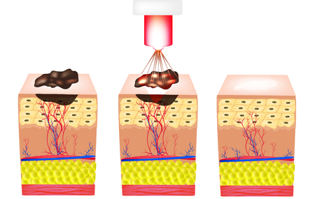 Removal of birthmarks, popiloma, wart laser. The structure of moles on the skin. Infographics. Vector illustration on isolated background.のイラスト素材