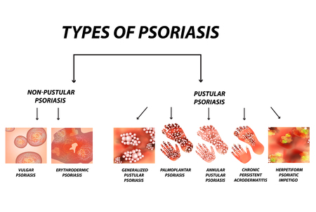 Types of psoriasis. Pustular and not pustular. Vulgar, erythroderma, erythrodermic psoriasis, persistent acrodermatitis, psoriatic impetigo. Eczema, skin disease dermatitis. Infographics. Vector illustration on isolated background.のイラスト素材