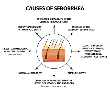 Causes of seborrhea. Seborrhea skin and hair. Dandruff, seborrheic dermatitis. Baldness, hair growth, baldness. Anatomical structure. Infographics. Vector illustration on isolated background.のイラスト素材