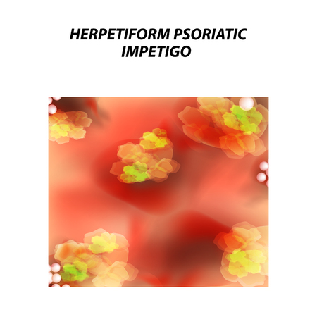 Herpetiform psoriatic impetigo. Eczema, dermatitis skin disease psoriasis. Infographics. Vector illustration on isolated backgroundのイラスト素材