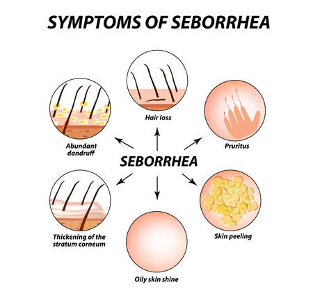 Symptoms of seborrhea. Seborrhea skin and hair. Dandruff, seborrheic dermatitis. Baldness, hair growth, baldness. Anatomical structure. Infographics. Vector illustration on isolated backgroundのイラスト素材