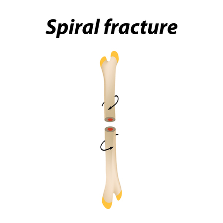 Spiral Bone Fracture. Infographics. Vector illustration on a lined backgroundのイラスト素材