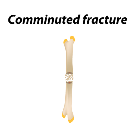 Comminuted fracture Bone. Infographics. Vector illustration on a lined backgroundのイラスト素材