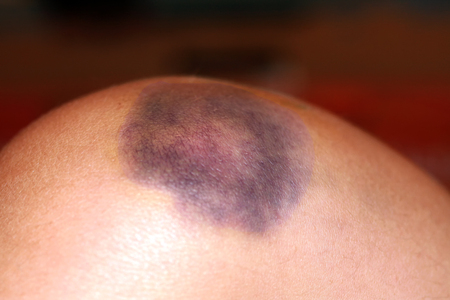 Injury of the knee joint. Big bruise on kneeの写真素材