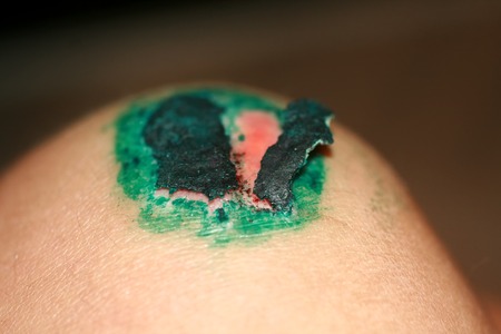 Healing wound on the knee. The wound treated with brilliant green. The scab will climbの写真素材