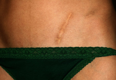 Scar on abdomen from operation of appendicitis. appendectomy scar.