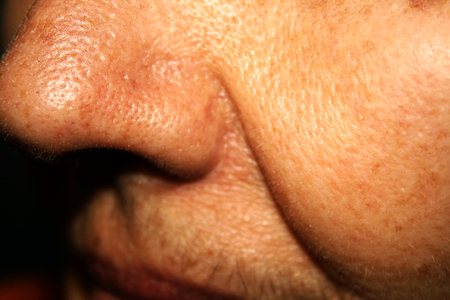 Nasolabial wrinkled fold on the skin of the face.の写真素材