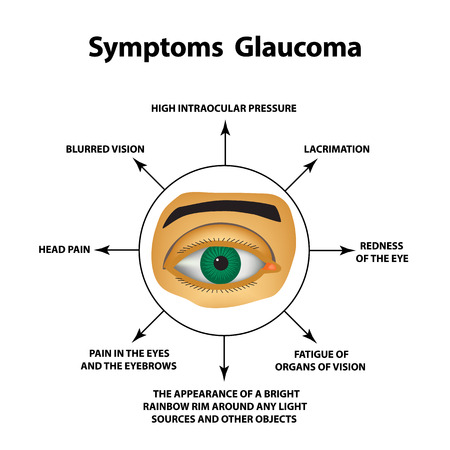 Symptoms of glaucoma. World glaucoma day. The anatomical structure of the eye. Infographics. Vector illustration on isolated background.のイラスト素材