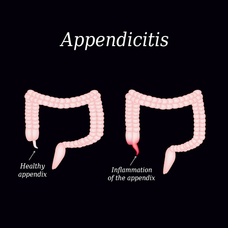 Appendicitis. Inflammation of the appendix. Colon. The illustration on a black background.のイラスト素材